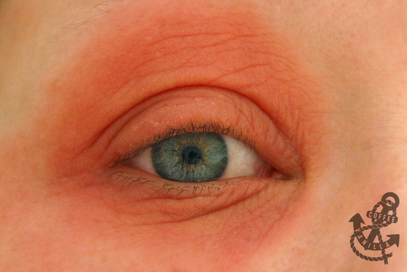 Blepharitis: Symptoms, Treatment, and Prevention