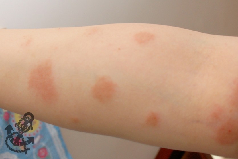 itchy eczema on hands swollen eyes neck arms