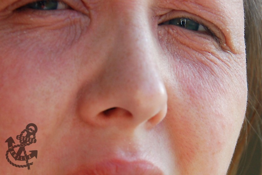 eczema chemical contact dermatisis