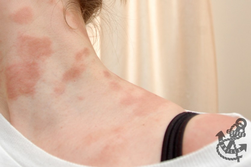 itchy patches on neck arms chest